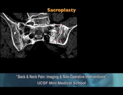 Embedded thumbnail for Vertebral bodies and sacral fractures