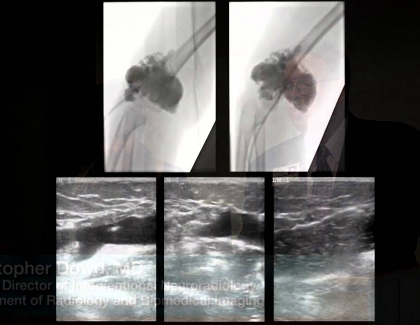 Embedded thumbnail for Lymphatic Malformation Cysts 