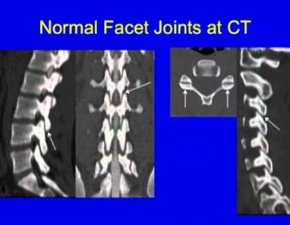 Embedded thumbnail for What is scoliosis?	