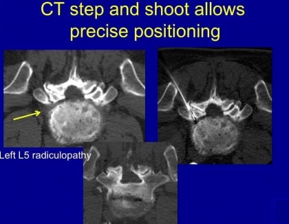 Embedded thumbnail for Advantages of CT Guided Injections