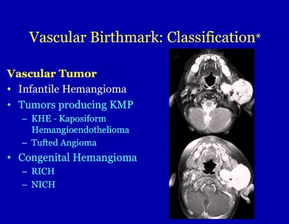 Embedded thumbnail for What Are Vascular Anomalies 