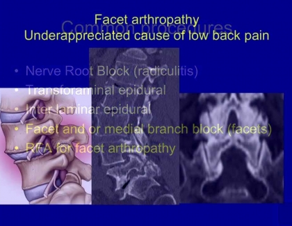 Embedded thumbnail for Facet Disease: An under-appreciated Cause of Lower Back Pain