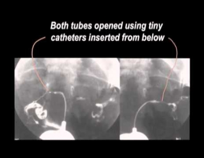 Embedded thumbnail for Treating blocked fallopian tubes