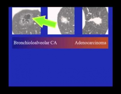 Embedded thumbnail for Is there a good vs. bad type of lung cancer?