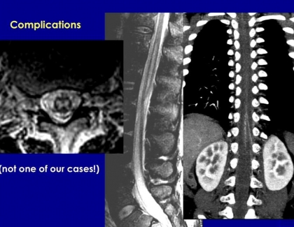 Embedded thumbnail for Safety Considerations for Spinal Injections
