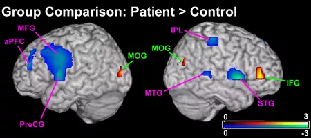 Resting MEGI Functional Connectivity in Schizophrenia predicts symptoms.