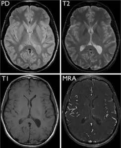 four axial brain images side by side showing PD, T2, T1, and MRA MRI sequences for comparison