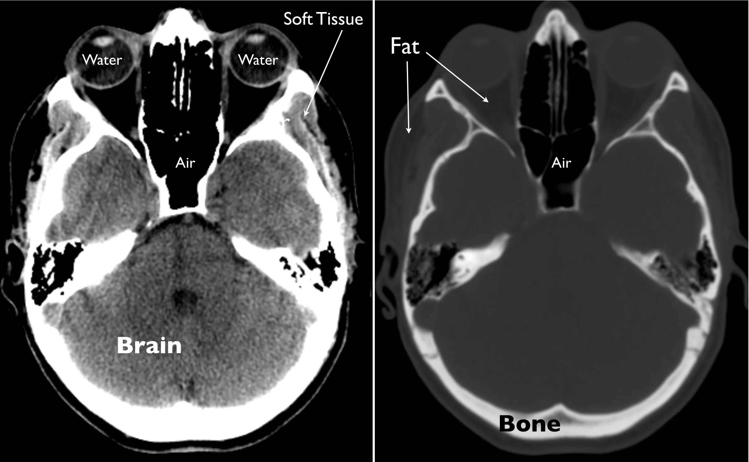 side-by-side axial CT images of the head showing a brain window on the left and a bone window on the right, with labeled areas for soft tissue, water, fat, and air