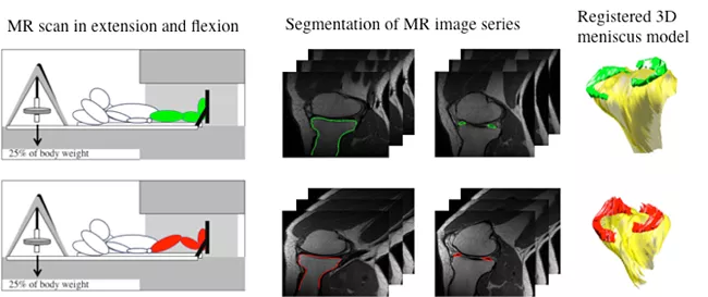 Diagram and MRI workflow showing knee MR scans in extension and flexion under partial body weight, followed by segmented MRI image series and corresponding registered 3D meniscus models, illustrating meniscus motion and kinematic analysis.