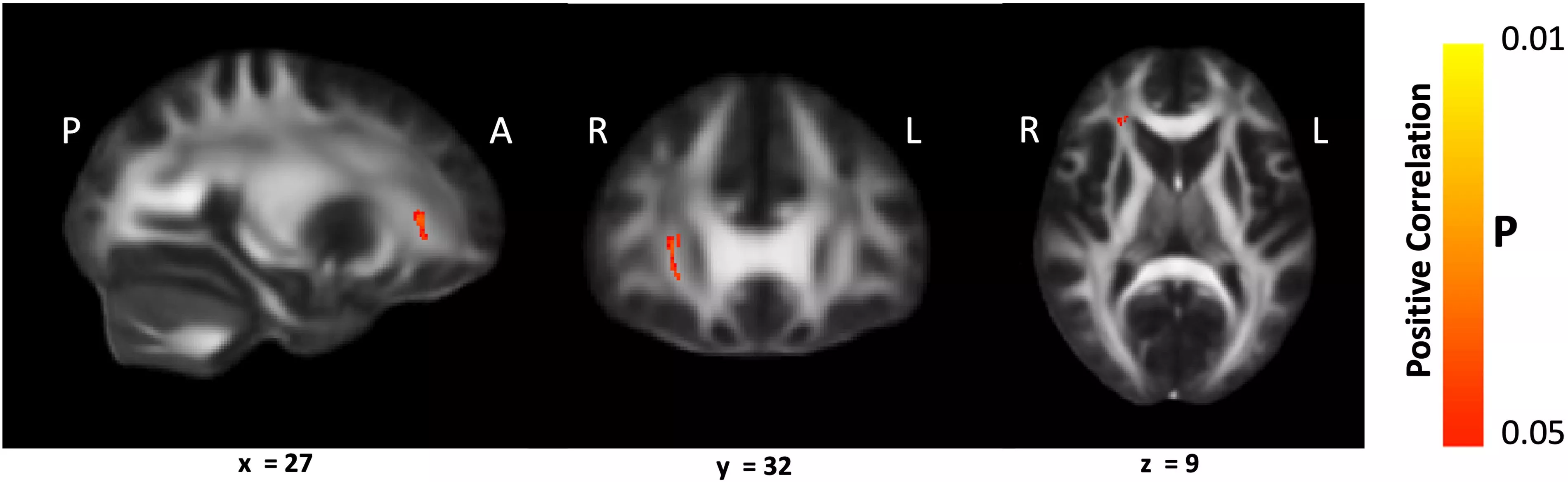 Sagittal, coronal, and axial brain MRI slices with small red highlighted clusters indicating areas of positive correlation. Orientation markers (P, A, R, L) and slice coordinates (x = 27, y = 32, z = 9) are shown. A vertical color bar labeled Positive Correlation displays p values ranging from 0.01 to 0.05.