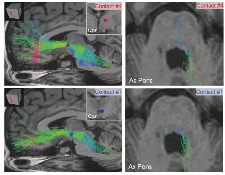 Sagittal and axial brain MRI images showing deep brain stimulation electrode contacts with colored tractography streamlines. Insets highlight electrode contact locations in coronal and axial views near the pons.
