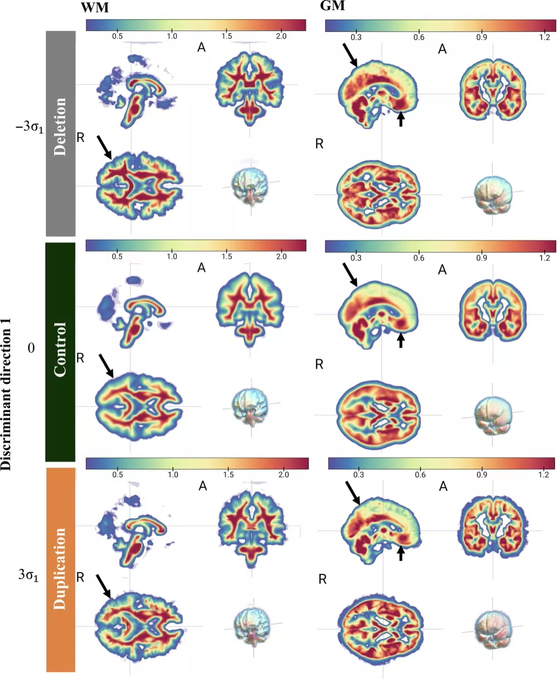 Heat map style brain images displaying white matter and gray matter differences across deletion, control, and duplication groups. Color bars indicate standardized effect sizes, with arrows highlighting regional differences.