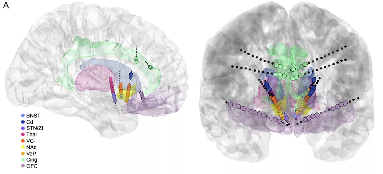 Transparent 3D brain renderings in sagittal and coronal views showing implanted electrode trajectories targeting multiple subcortical regions. Color coded targets include BNST, caudate, thalamus, nucleus accumbens, ventral capsule, cingulate, and orbitofrontal cortex.