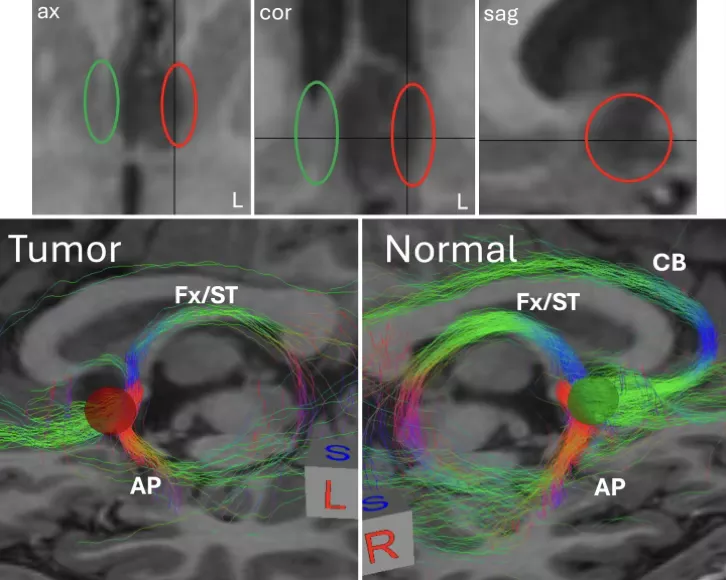 Composite brain MRI images showing axial, coronal, and sagittal views with highlighted regions and tractography. Side by side comparison labeled Tumor and Normal demonstrates white matter fiber pathways connecting frontal cortex and subcortical structures, with colored streamlines indicating altered connectivity near a lesion.