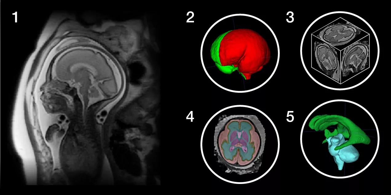 Fetal brain MRI with segmented anatomical regions and 3D visualizations