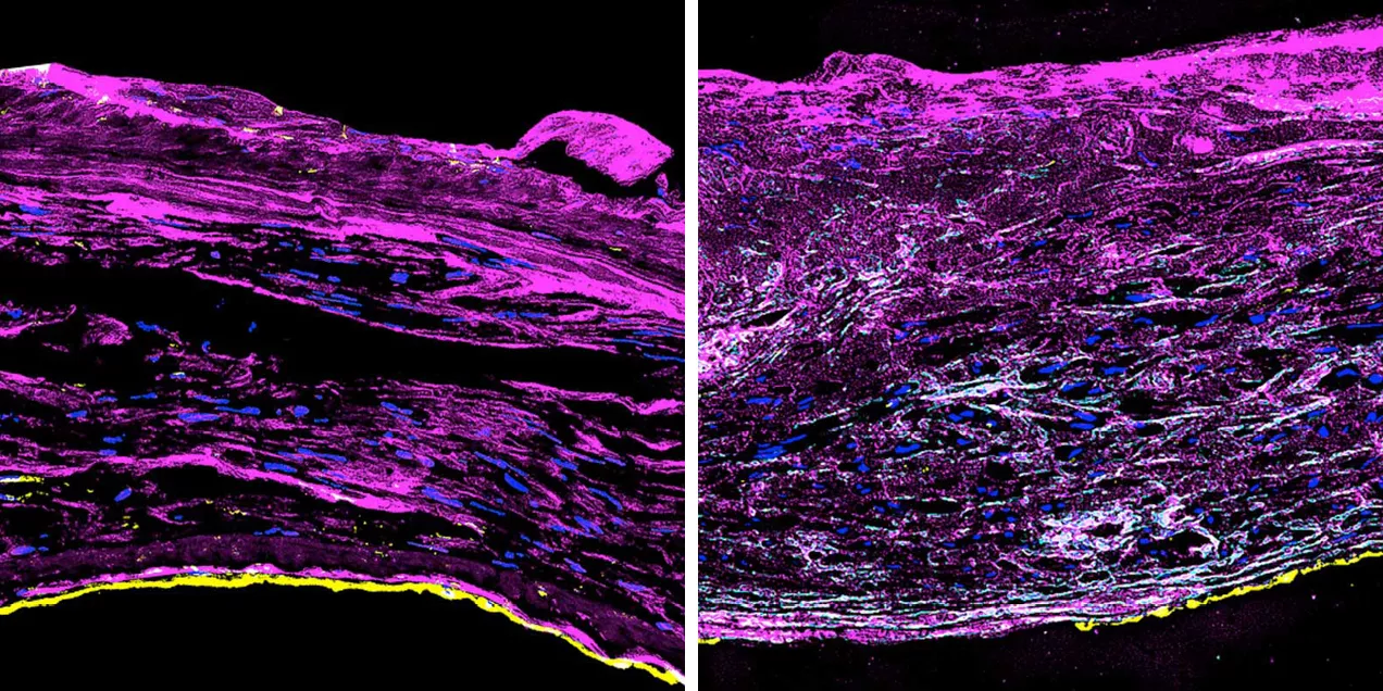 Side-by-side microscopic images comparing a healthy artery wall (left) and an aneurysm vessel wall (right). The healthy artery shows organized, layered tissue structures, while the aneurysm wall appears disorganized and densely remodeled with irregular tissue architecture. Bright pink staining highlights connective tissue, with blue and yellow markers indicating specific cellular or structural components against a black background. The comparison illustrates the structural changes associated with aneurysm f