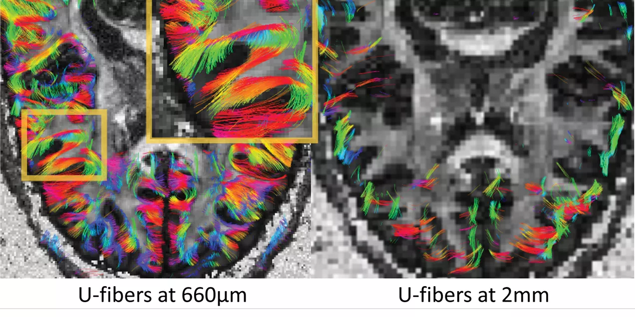 Comparison of high- and standard-resolution diffusion MRI images highlighting the increased detail of U-fiber pathways at 660 µm compared with 2 mm resolution.