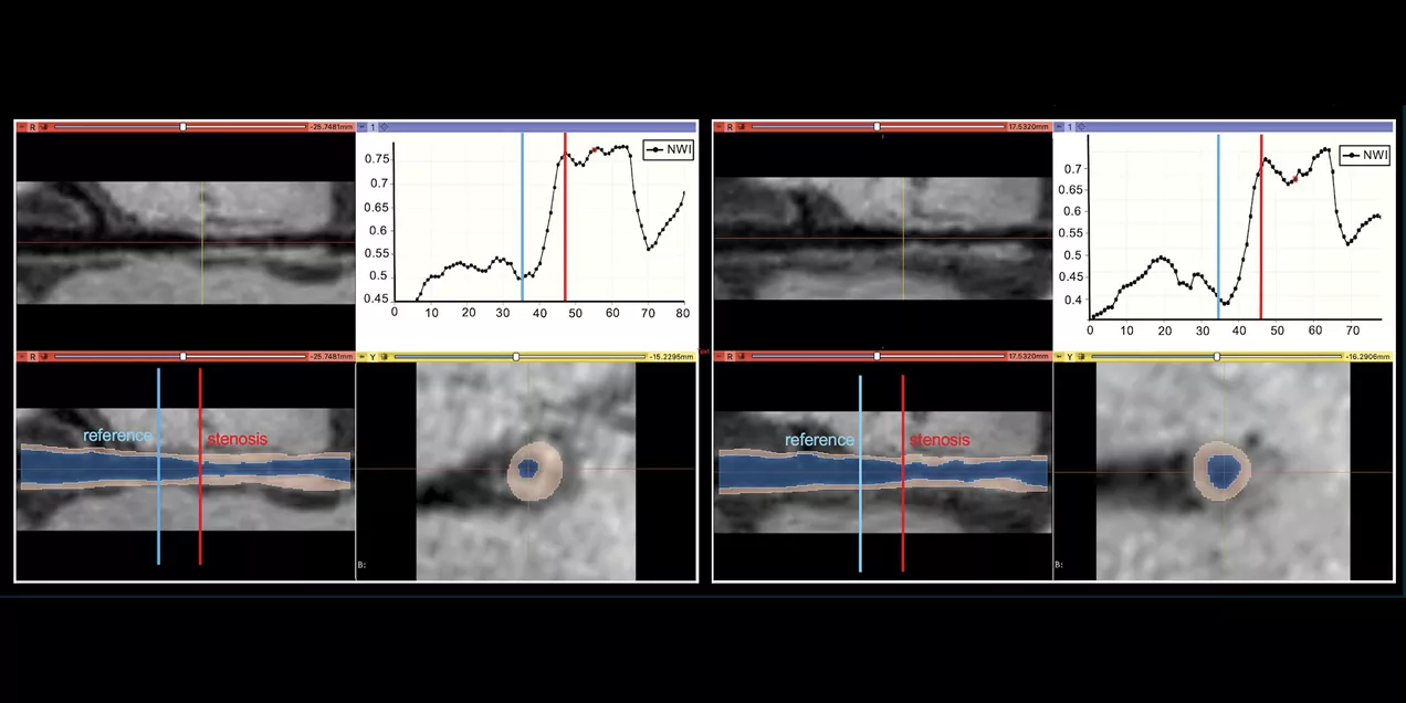 Vessel wall imaging analysis software showing longitudinal and cross-sectional artery views, with reference and stenosis locations marked and corresponding normalized wall index (NWI) graphs.