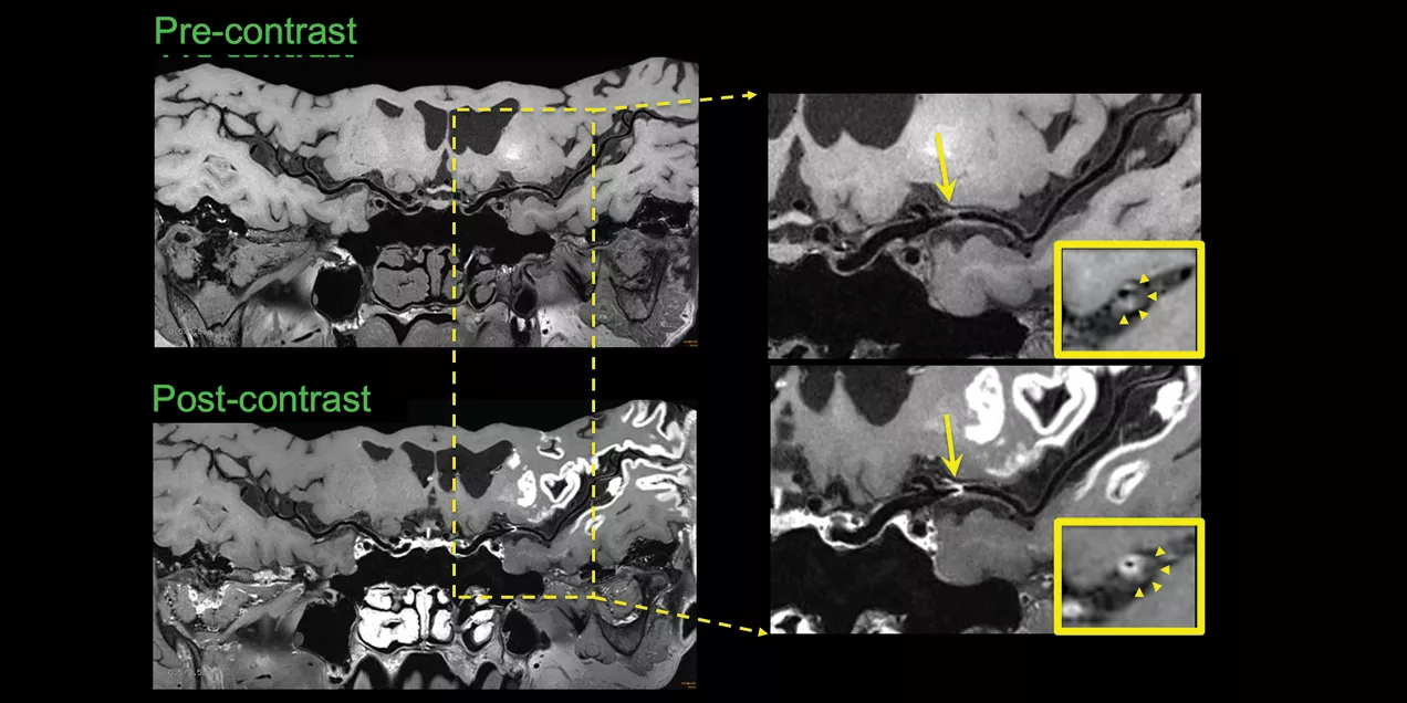 Pre- and post-contrast brain vessel wall MRI images showing a narrowed intracranial artery, with enlarged views highlighting the vessel wall and areas of enhancement.