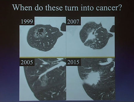 When do these lung nodules turn into cancer?