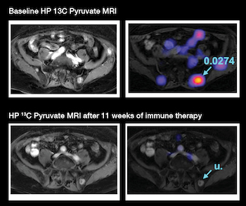 Hyperpolarized [1-13C] pyruvate MRI for metabolic assessment of prostate cancer osseous metastases following immune therapy.