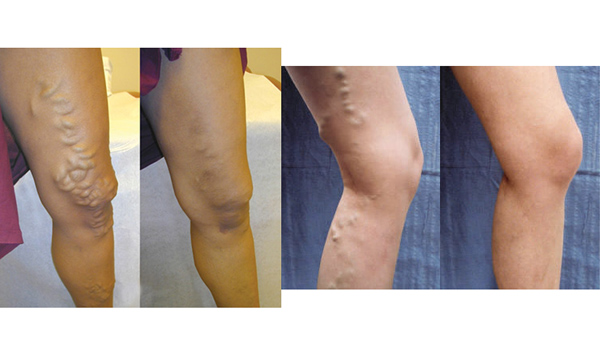 What should I do to prevent varicose veins from coming back?