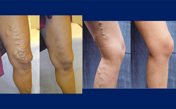 Minimally Invasive Treatment for Varicose Veins Now Available to