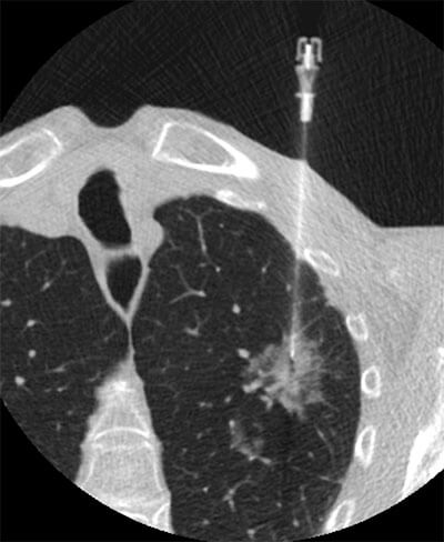 CT guided lung biopsies