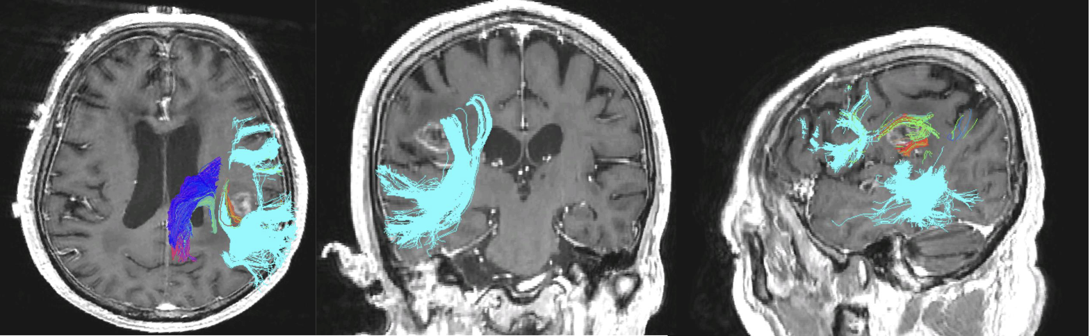 Image of a brain scan showing motor pathways in blue and language pathways in cyan, green, and orange.