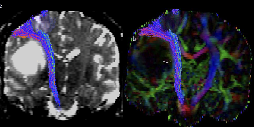 Brain scan showing a tumor surrounded by brain pathways in blue and purple