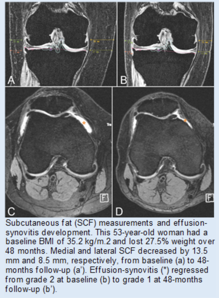 Scan of a knee showing synovitis in osteoarthritis.