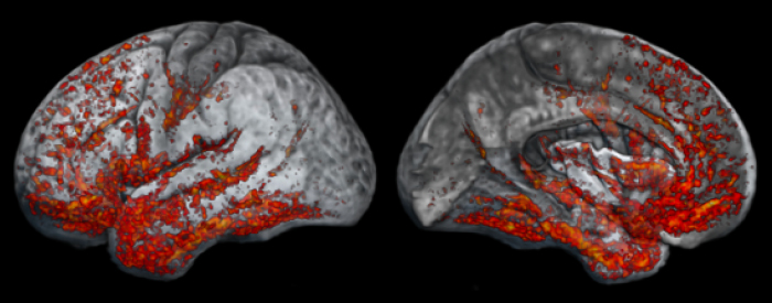 Scan of a brain with areas highlighted