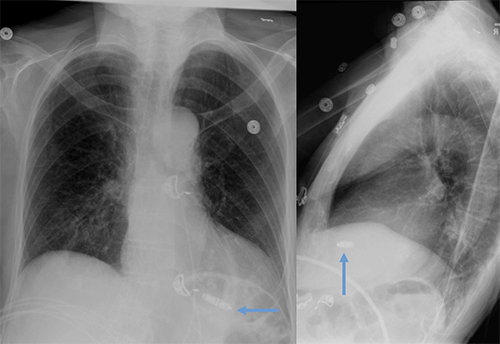 Leadless pacemaker