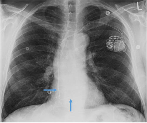 Pacemaker with transvenous leads