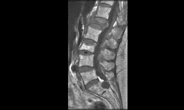 DXA image of spine