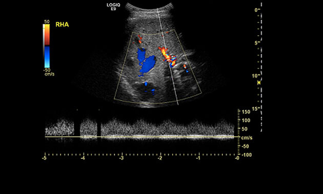 Liver Arteriovenous Malformation (AVM) Ultrasound