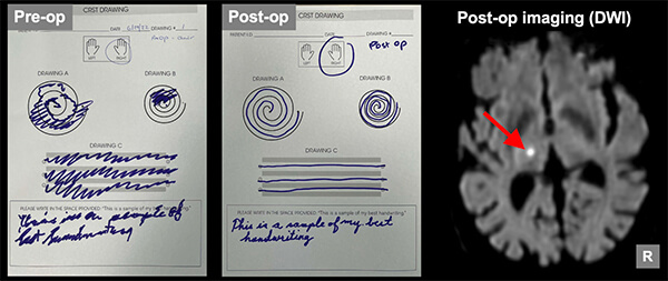 Drawings by a patient with essential tremor before and after HIFU treatment.