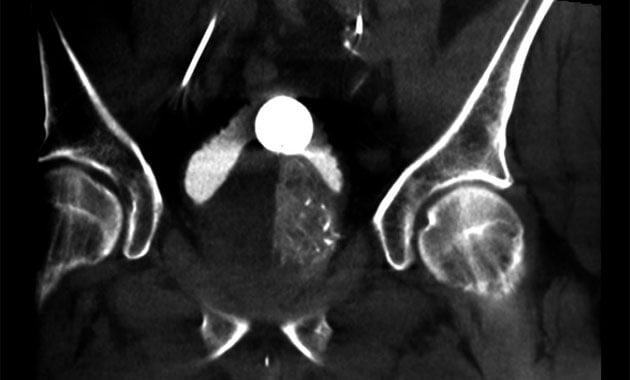 Cone-Beam CT obtained during PAE