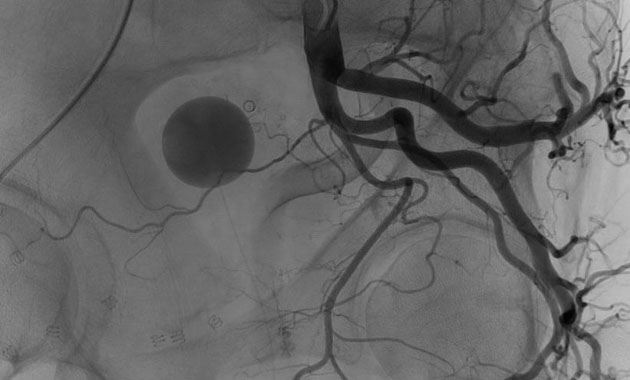 Prostate Artery Embolization (PAE)