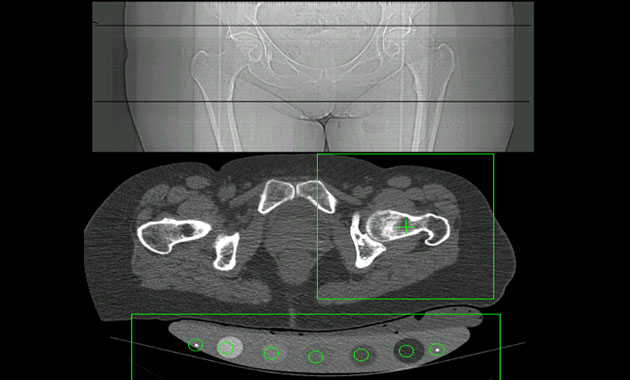 Bone Density DEXA Scan – Crown Valley Imaging