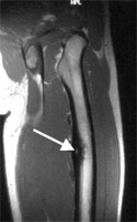 MRI of Osteoid Osteoma