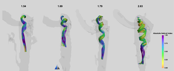 Vzory průtoku jugulární žíly u pacientů s pulzujícím tinnitem pomocí výpočetní dynamiky tekutin