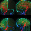 Prominent Condylar Veins Causing Pulsatile Tinnitus: Dynamic Angiographic Confirmation