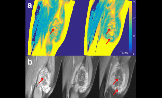 High intensity focused ultrasound (HIFU) treatment of soft tissue tumor - Viola Rieke Tognina, PhD