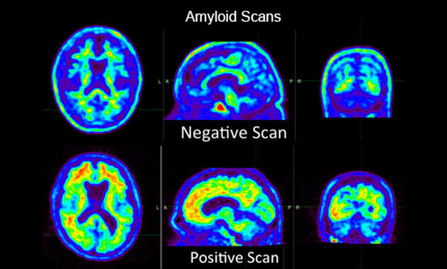 Amyloid PET Scan for Alzheimer's Disease Assessment