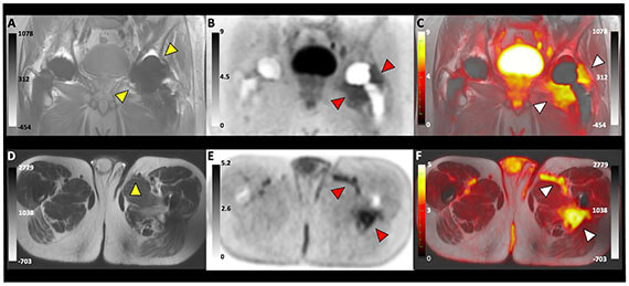 Imaging joint infections using D-methyl-11C methionine PET/MRI: initial experience in humans