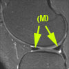 MR Images of knee cartilage, ACL, and menisci